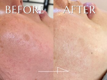 神門 メディカルラボ MEILI院(MedicalLab)/30代 | 女性 | ハーブピーリング