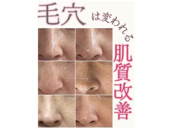 マヴィ 藤井寺店(MavY.)/毛穴洗浄×水光注入で美毛穴へ