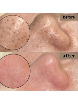 ティーティービューティ 名古屋金山店(TTBeauty)/毛穴エクストラクション