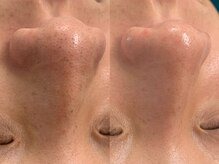 リメイククリニカルビューティー(Remake clinical beauty)/【施術症例】リメイク毛穴洗浄