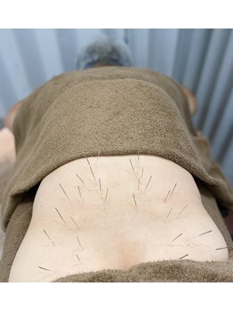 ウル鍼灸整骨院/はりきゅう施術