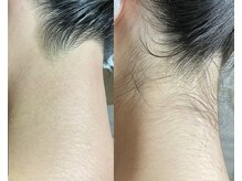 アンビジュ(un bijou)/うなじ(WAX脱毛のみ)