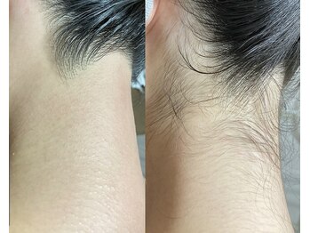 アンビジュ(un bijou)/うなじ(WAX脱毛のみ)