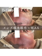エピナ 横浜店(Epina)/メンズフェイシャル光脱毛+WAX☆