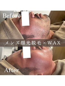 エピナ 横浜店(Epina)/メンズフェイシャル光脱毛+WAX☆