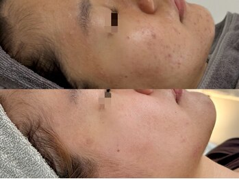 ピブ(PIBU)/ニキビ症例/ハーブピーリング