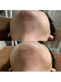 リラチル(relachill)/ヒゲ脱毛