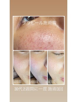 アデージョ(Adejio)/ララピール