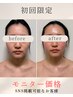 【お顔】新規モニターダウンタイム短縮★術後ケアインディバ(40分)