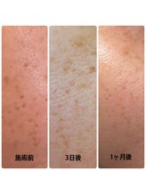 ジェシカ 武蔵小金井店/光フェイシャル☆