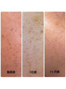 ジェシカ 武蔵小金井店/光フェイシャル☆