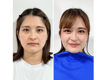 エピファニー 東京 銀座/ビフォーアフター(N.H様 20代)