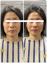 長寿鍼灸院 長寿整骨院/美容鍼25本の効果★小顔効果