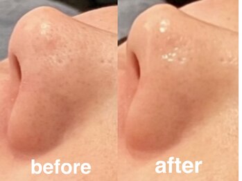 ヴィセラ(Vicella)/小鼻ツルツル!