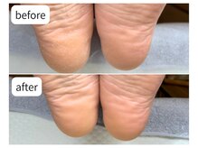 カシェット(Cachette)/40代女性◎足裏角質 かかと40分