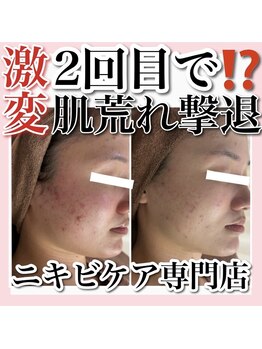 ホワイトアクア 天王寺本店(WHITE AQUA)/ハーブピーリング/大阪/天王寺