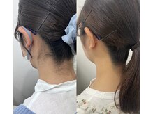 ミース 長野店/うなじ矯正◆ビフォーアフター
