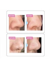 ハンズ(Han頭)/毛穴洗浄