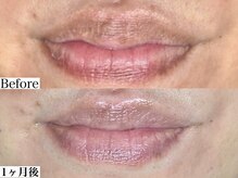 エモーショナル 姫路(Emotional)/韓国で大人気！ルメラの経過