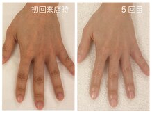 キレイテ 福岡天神店/40代/5回目【天神ハンドケア】