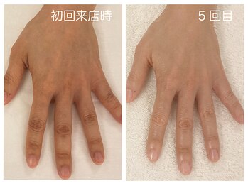 キレイテ 福岡天神店/40代/5回目【天神ハンドケア】