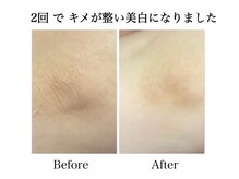 ナチュラーレ 天王寺店(Naturale)/美肌ニキビケア肘ブライダル