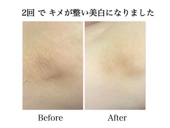 ナチュラーレ 天王寺店(Naturale)/美肌ニキビケア肘ブライダル