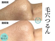 リッカロッカ(RIKKA&ROCCA)/毛穴エクストラクション