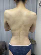 FJ/背中脂肪◆腰上脂肪も!!撃退