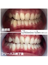 ホワイトニングサロン 京都烏丸店/ホワイトニング施術例