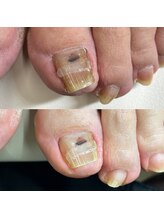 リリ(lili)/巻き爪矯正2回目（左親指）