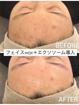ネオファースト 大阪福島店(NeoFirst)/艶肌フェイスwax＋美容導入