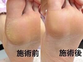 【お得】上質フット角質ケア