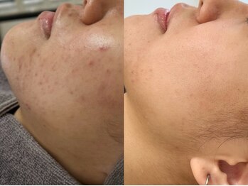 ピブ(PIBU)/ニキビ症例/ハーブピーリング