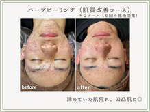 べセラ(BESERA)の雰囲気(【効果が気になる方必見】Before→Afterはフォトギャラリーへ)
