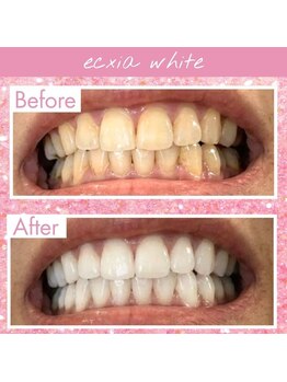 エクシアホワイト 新宿御苑店(ecxia white)/ホワイトニングビフォーアフター