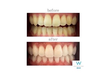 ホワイトニングショップ 越谷店/before&after美白ホワイトニング