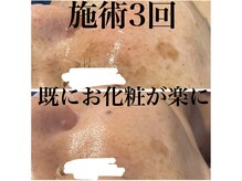 サロンツキ(salon tuki)/【光フォト】症例