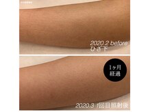 フローレント(Florent)/ひざ下脱毛