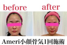 小顔矯正 アメリ ビューティーサロン(Ameri beauty salon)