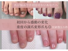 ティアラネイル(tiaranail)の雰囲気（栃木初リプロ深爪矯正導入！即日見た目が変わる。変形爪にも◎）