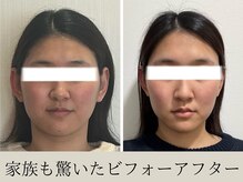 オルビナ(Orbina)/小顔矯正