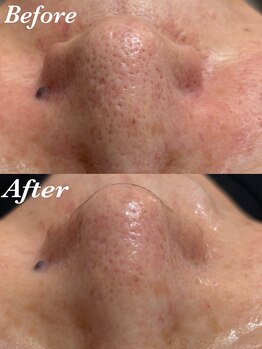 コリー(Kolly)/毛穴の凸凹も綺麗に！