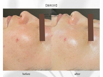 アン ビューティー(ann beauty)/施術2回【症例写真】30代