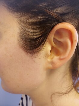 キアラ 麻布十番(Kiara)/もみあげ脱毛