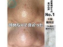 リッカロッカ(RIKKA&ROCCA)/毛穴エクストラクション