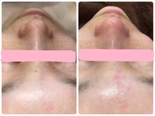 エルマナ(Hermana)/毛穴ケアビフォーアフター