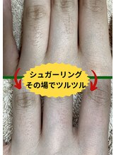 ディスイズミー シュガーリング(This is me Sugaring)/【シュガー】産毛も脱毛可能