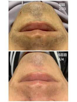 リリーサロン 松本平田店(LILYSalon)/まずはヒゲ脱毛からでも◎