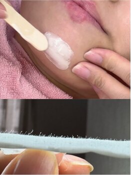 エマ(emma)の写真/産毛や古い角質を除去してゆで卵のようなうるつや肌に♪お顔の産毛もスッキリでお化粧ノリもUP！